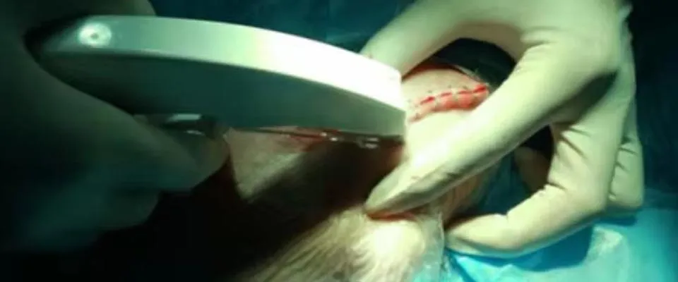 Disposable Skin Stapler Overview