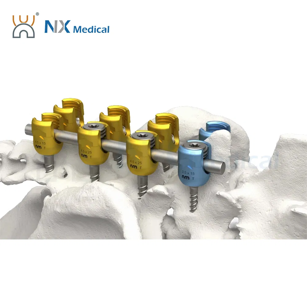 Nx Medical Spine Implant Spinal Pedicle Screw 5.5mm System Titanium OEM ODM for Fixation