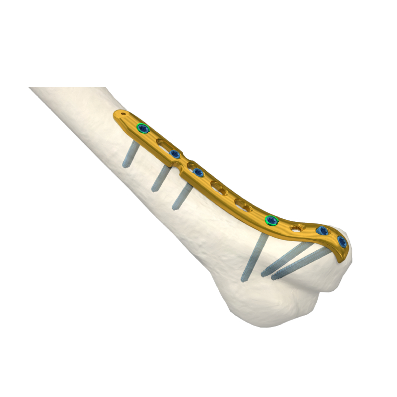 Orthopedic Surgical Titanium Implants Distal Lateral Humeral Locking Plate Trauma Surgery LCP