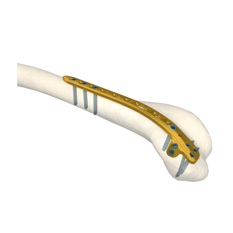 Orthopedic Surgical Titanium Implants Distal Lateral Humeral Locking Plate Trauma Surgery LCP