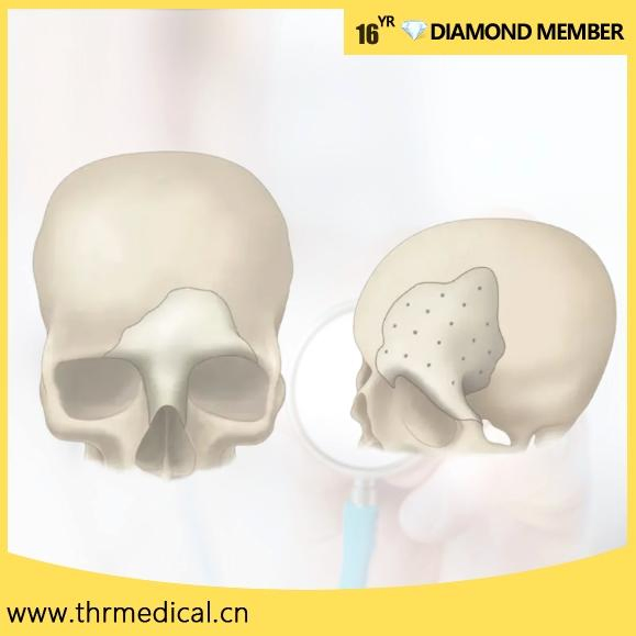 Surgical Peek Patient Specific Implant for Craniomaxillofacial Repair and Fixation