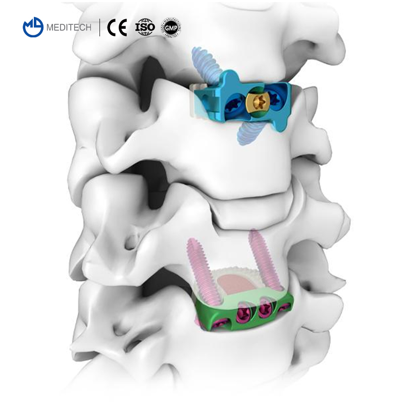 Orthopedic Implant Protesis Spinal Implants Spine Medical Orthopedic Implant Cervical Peek Cage