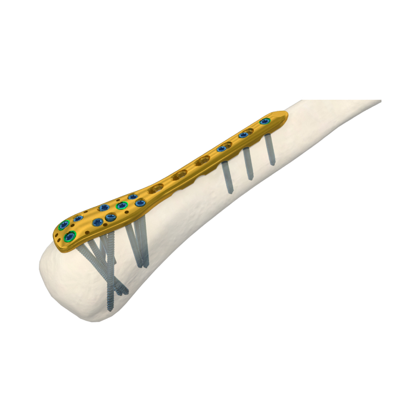 Orthopedic Surgical Titanium Implants Distal Lateral Humeral Locking Plate Trauma Surgery LCP