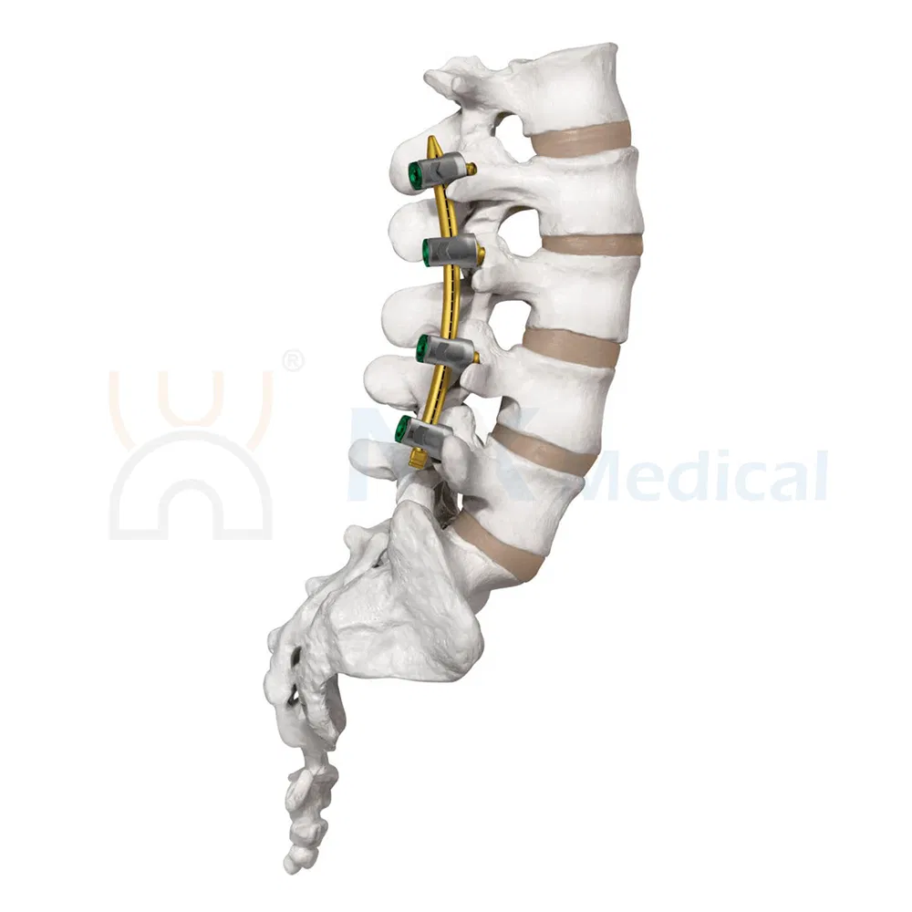 Nx Medical Spine Implant Spinal Pedicle Screw 5.5mm System Titanium OEM ODM for Fixation