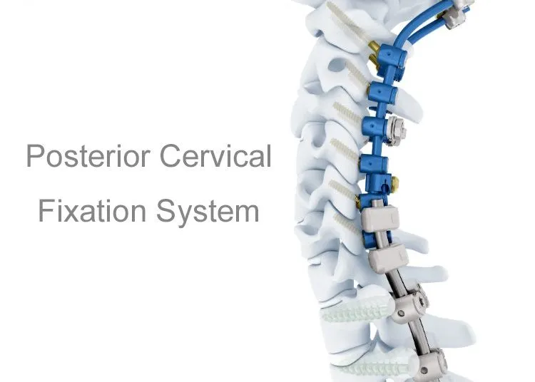 Orthopedic Surgical Implants