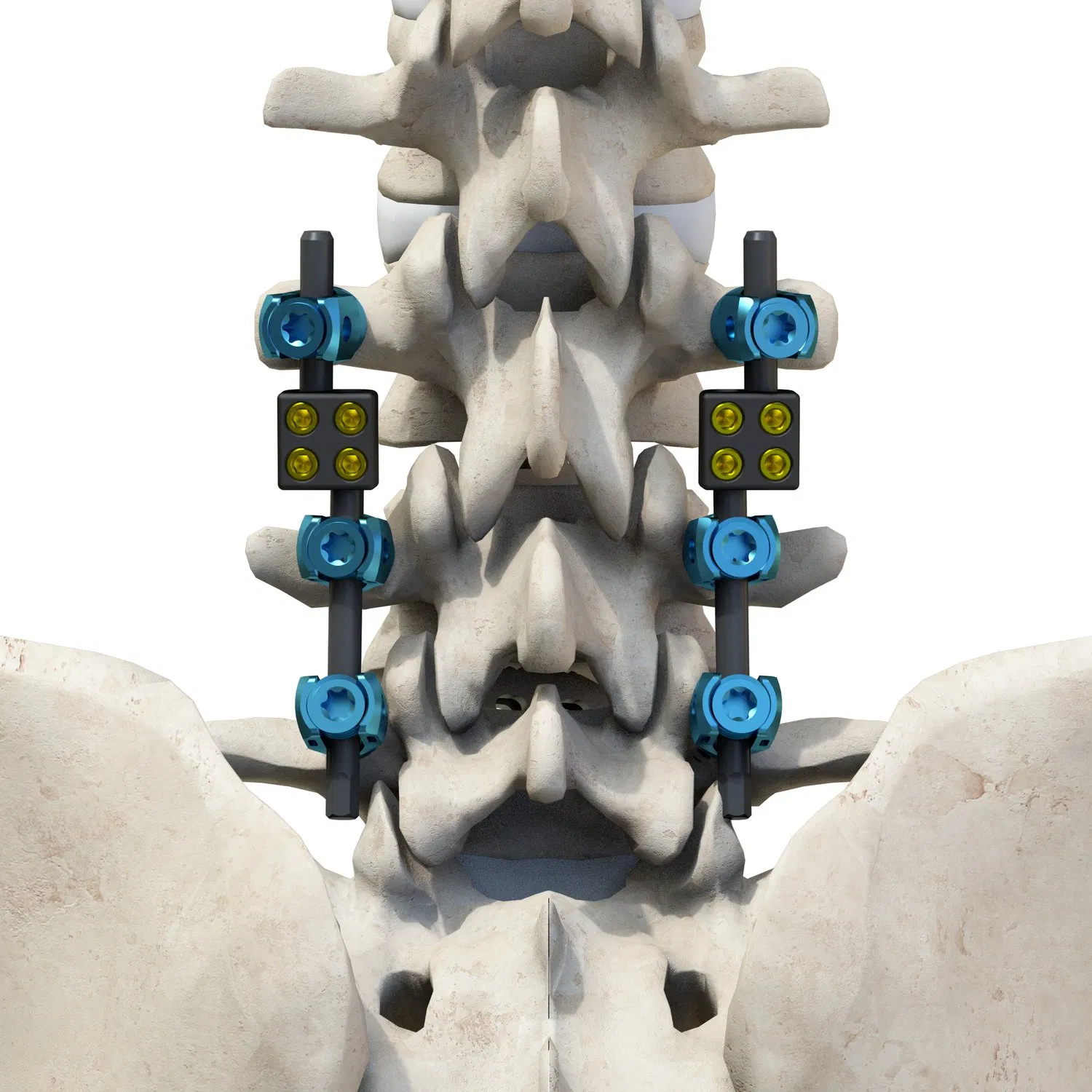 Premium Tc4 Titanium Alloy Thoracolumbar Spinal System 6.0