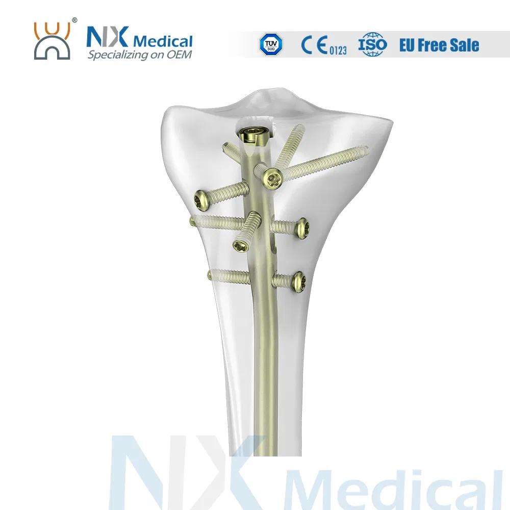 Nx Medical Orthopedic Implant Trauma Proximal Tibial Interlocking Intramedullary Nail China Factory