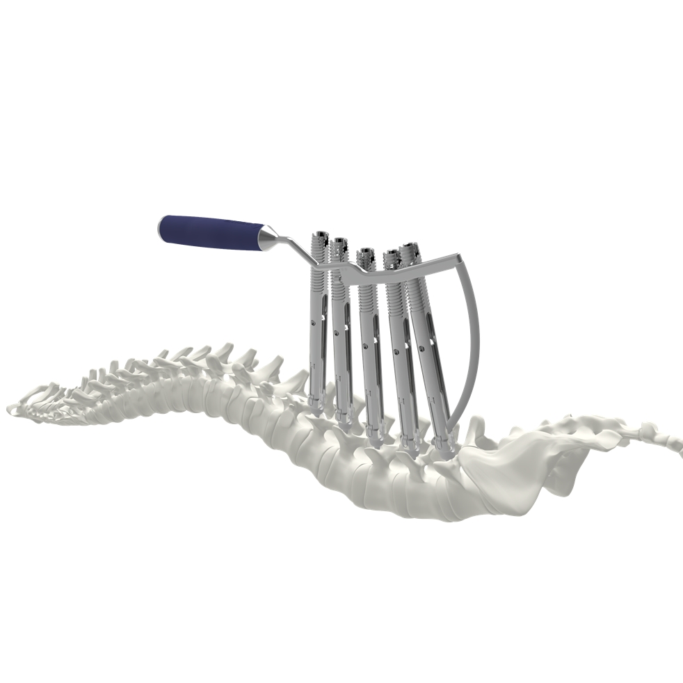 Advanced Type-II Cocrmo Polyaxial Pedicle Screw System for Spinal Surgery