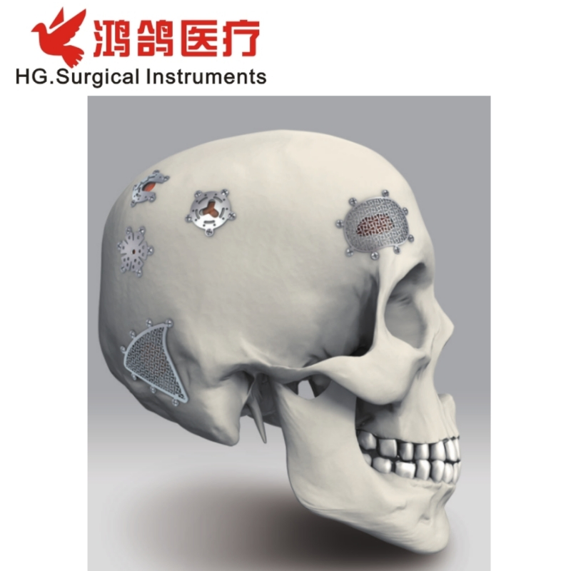 Orthopedic Minimally Invasive Titanium Mesh Orthopedic Implant Bone Plate Hospital Equipment