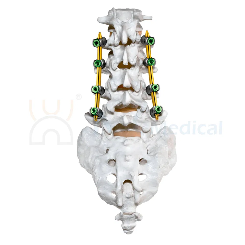 Nx Medical Spine Implant Spinal Pedicle Screw 5.5mm System Titanium OEM ODM for Fixation