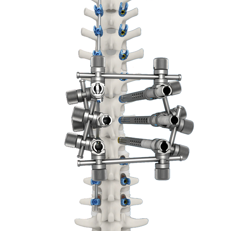 Advanced Titanium Posterior Rod-Screw System for Spinal Correction