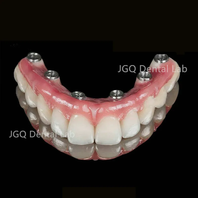 Custom implant bridge