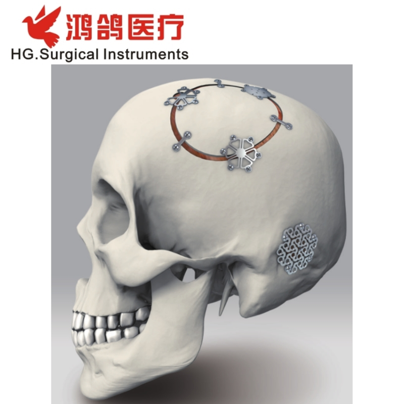 Orthopedic Minimally Invasive Titanium Mesh Orthopedic Implant Bone Plate Hospital Equipment