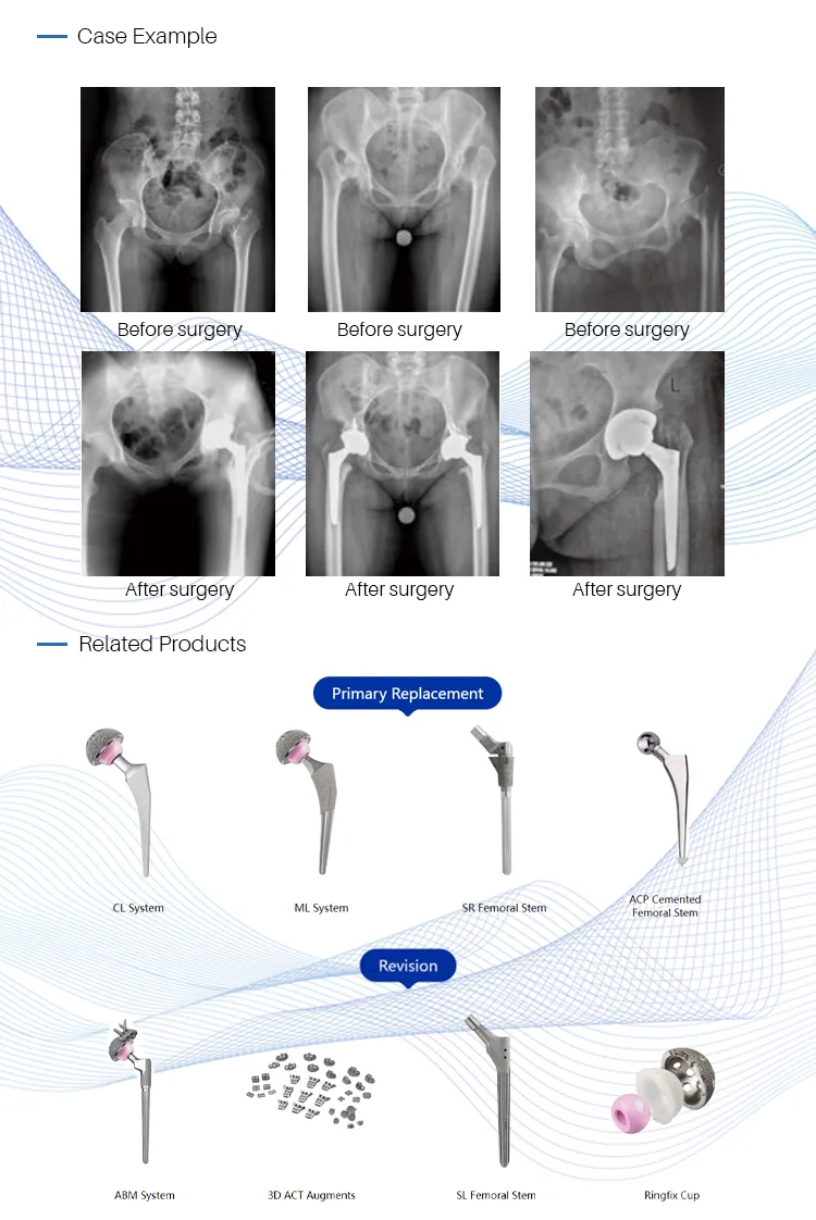 Primary Knee Prosthesis Details