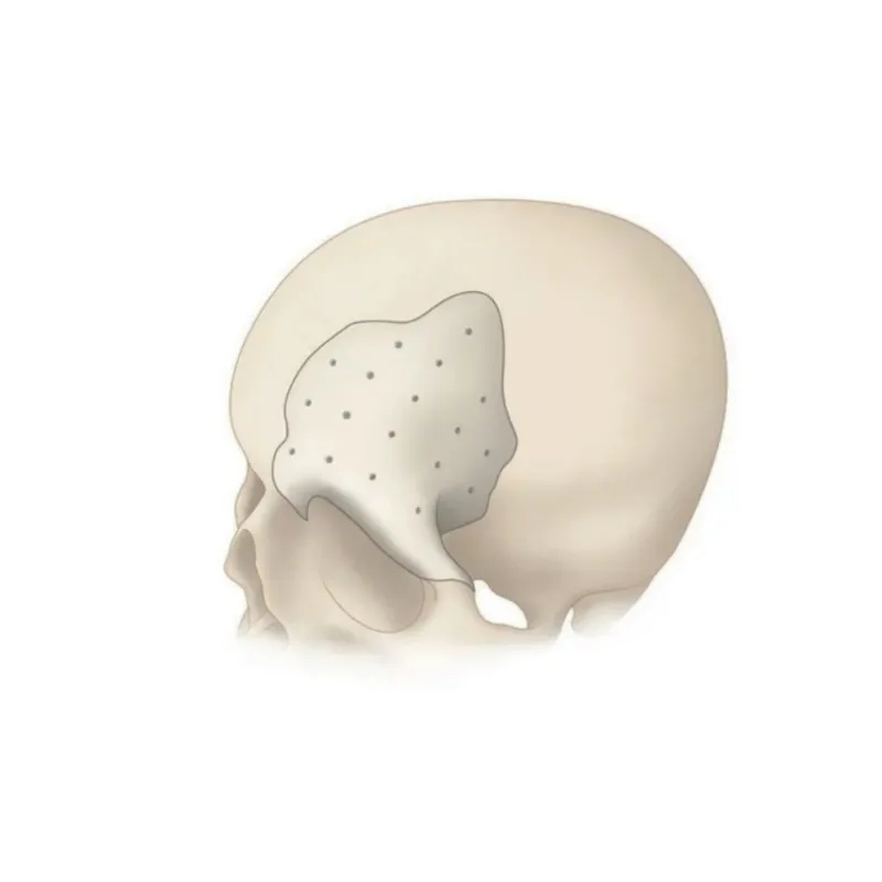 Surgical Peek Patient Specific Implant for Craniomaxillofacial Repair and Fixation