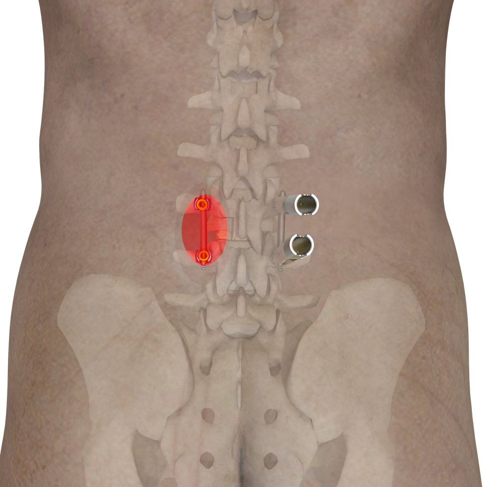 Advanced Type-II Cocrmo Polyaxial Pedicle Screw System for Spinal Surgery
