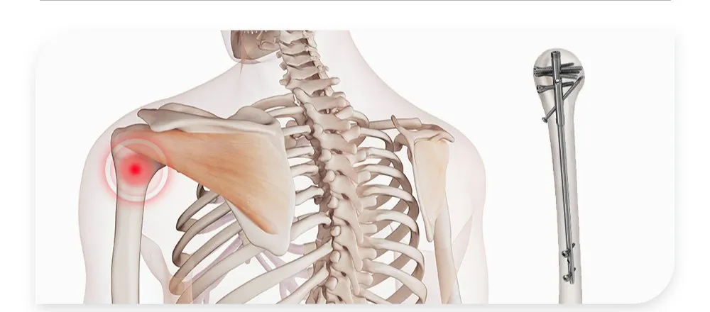 Humerus Multi-Lock Function
