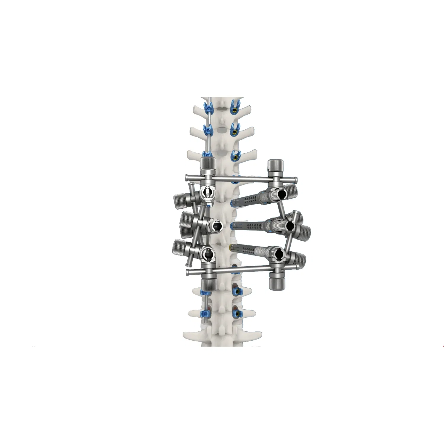 Premium Tc4 Titanium Alloy Thoracolumbar Spinal System 6.0