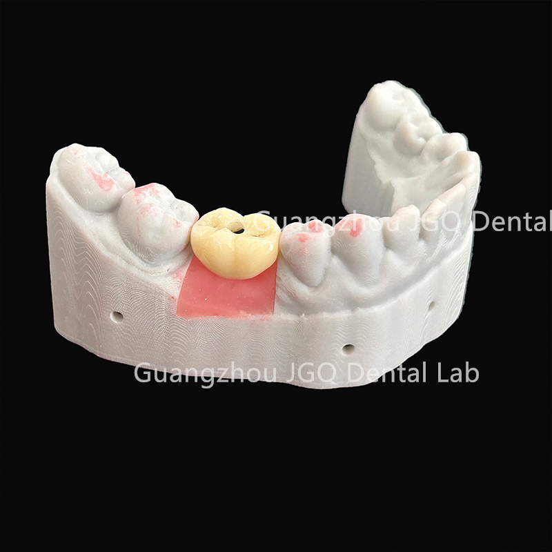 China Dental Lab Implant Product Offers Customizable Solution to Meet The Specific Needs of Each Patient