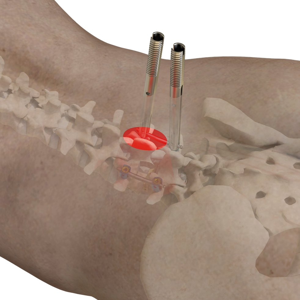 Advanced Type-II Cocrmo Polyaxial Pedicle Screw System for Spinal Surgery