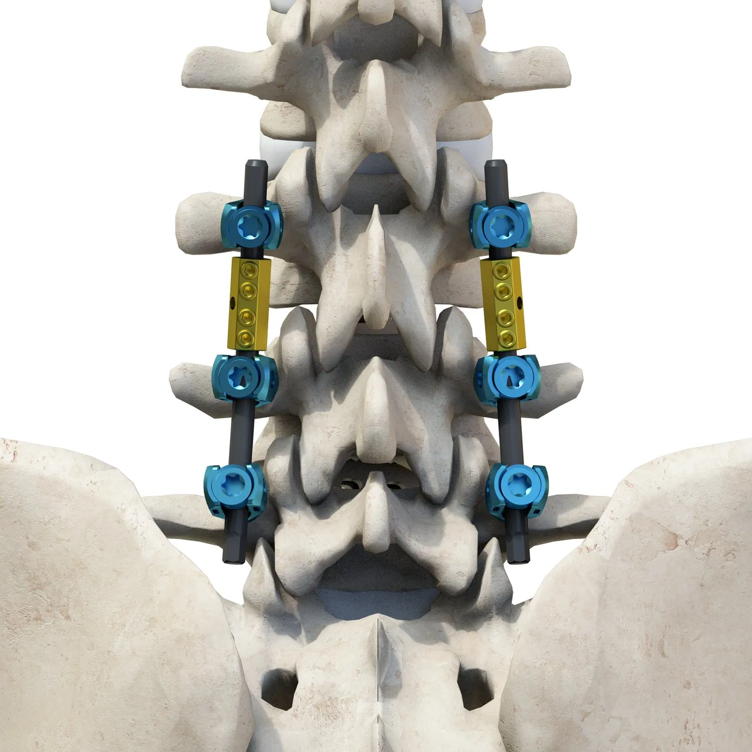 Premium Tc4 Titanium Alloy Thoracolumbar Spinal System 6.0