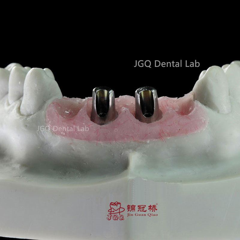 China Dental Lab Implant Product Offers Customizable Solution to Meet The Specific Needs of Each Patient