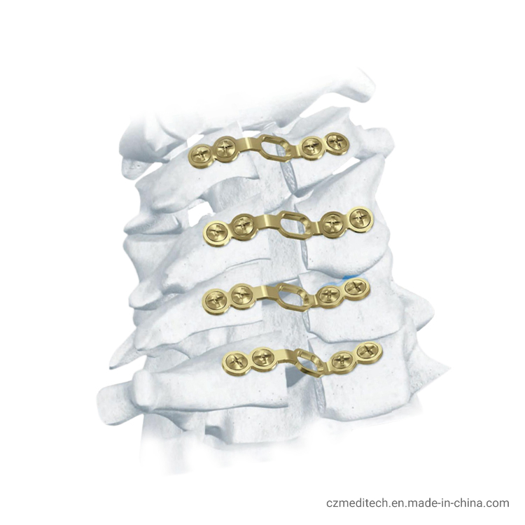 Titanium Plate Implant Orthopedic Implant Protesis Spinal Implants Spine Medical Orthopedic Implant Cervical Laminar Plate
