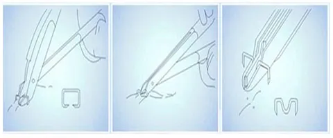 Skin Stapler Remover