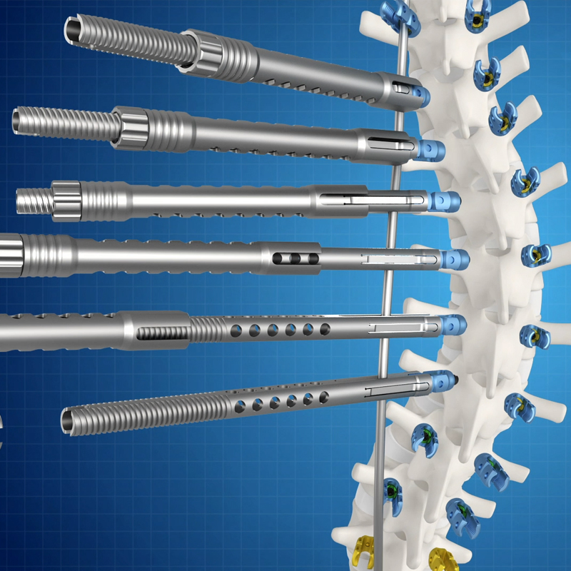 Reliable Cortical Bone Thread Screw for Iliac Fixation