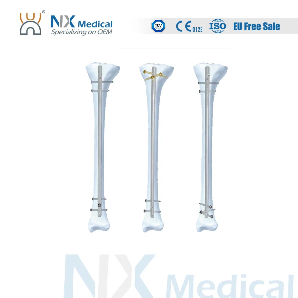 Nx Medical Orthopedic Implant Trauma Proximal Tibial Interlocking Intramedullary Nail China Factory