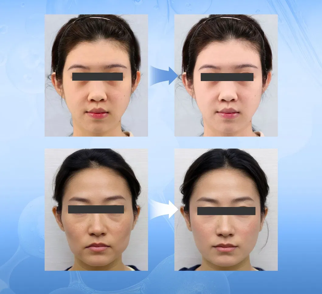 Before and After Results