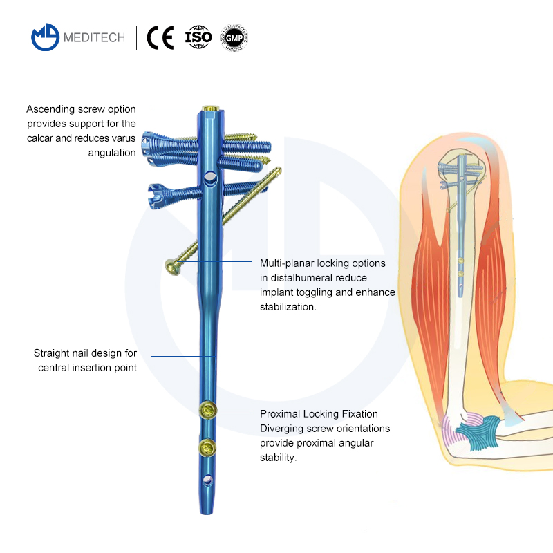 Medical Supply Orthopedic Implant Titanium Interlocking Humerus Nail Multi-Lock Humeral Intramedullary Nail