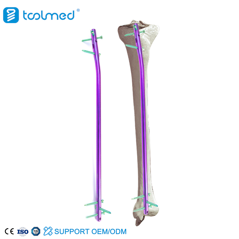 Intramedullary Nailing of Tibia Assured Quality Expert Tibia Intramedullary Nail Instrument Set
