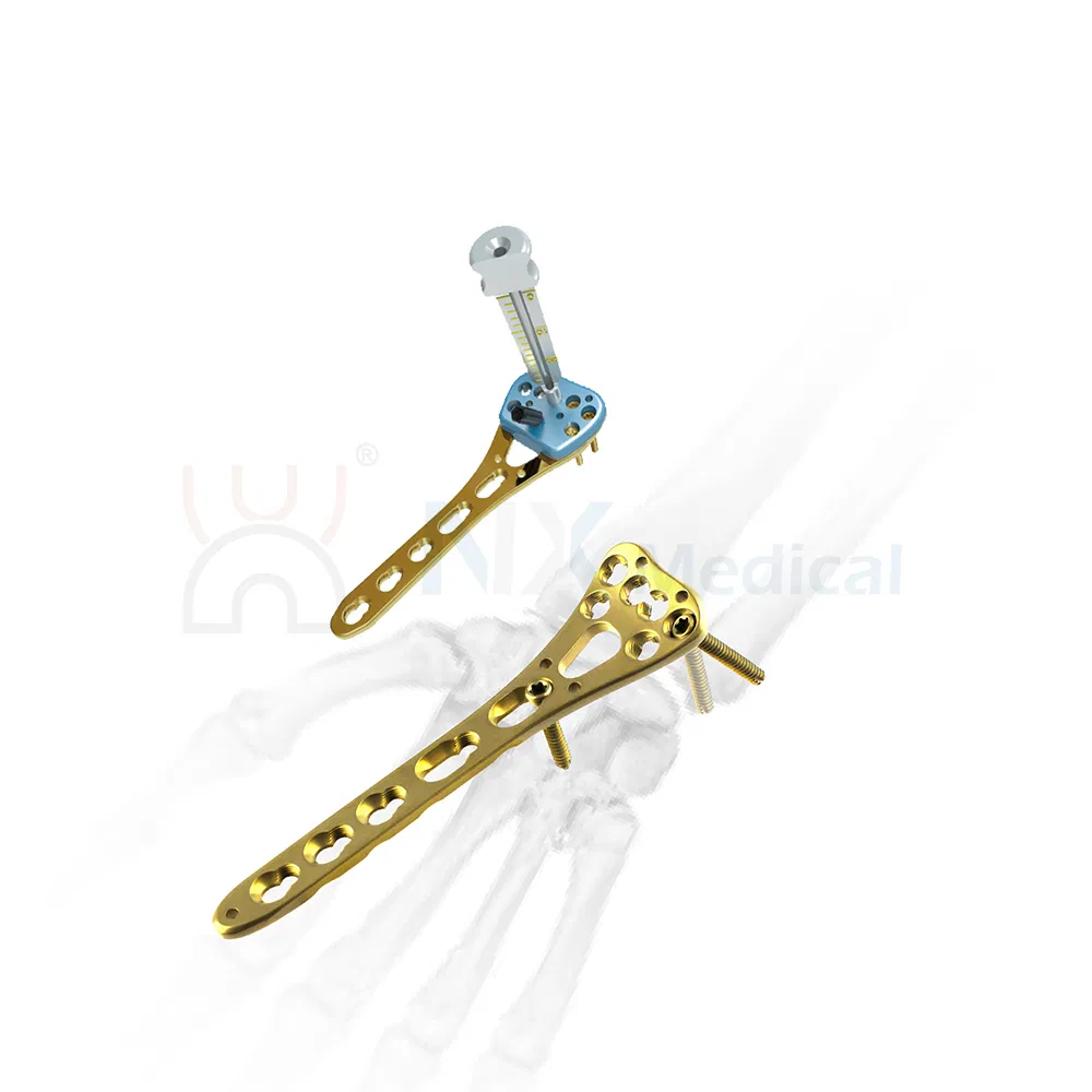 Nx Medical Variable Angle Locking Compression Plate Radius Fragment System for Orthopedic