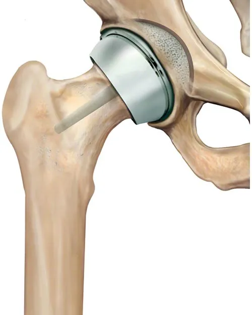 Knee Replacement Component