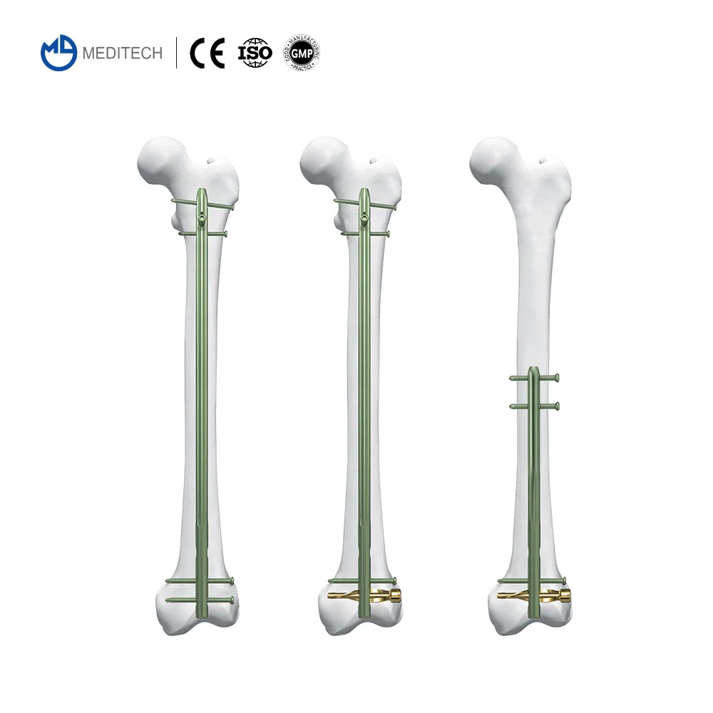 Titanium Orthopedic Surgical Implant Suprapatellar Approach Tibial Intramedullary Nail