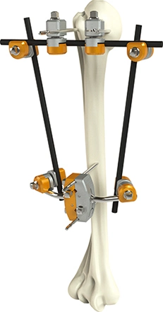 Hot Selling Combination External Fixator -Proximal Humerus Fixator