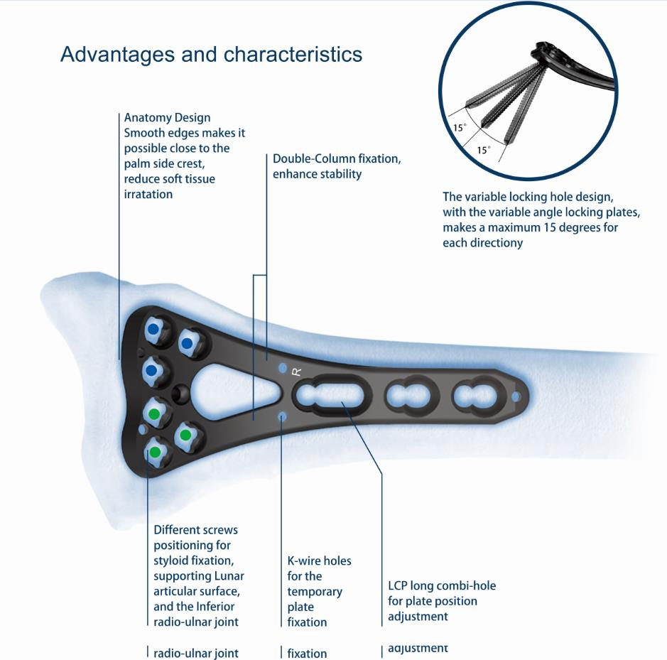 Ao Type Vlp Locking Distal Radius Titanium Bone Plate and Screw Orthopedic Instrument Medical Implants