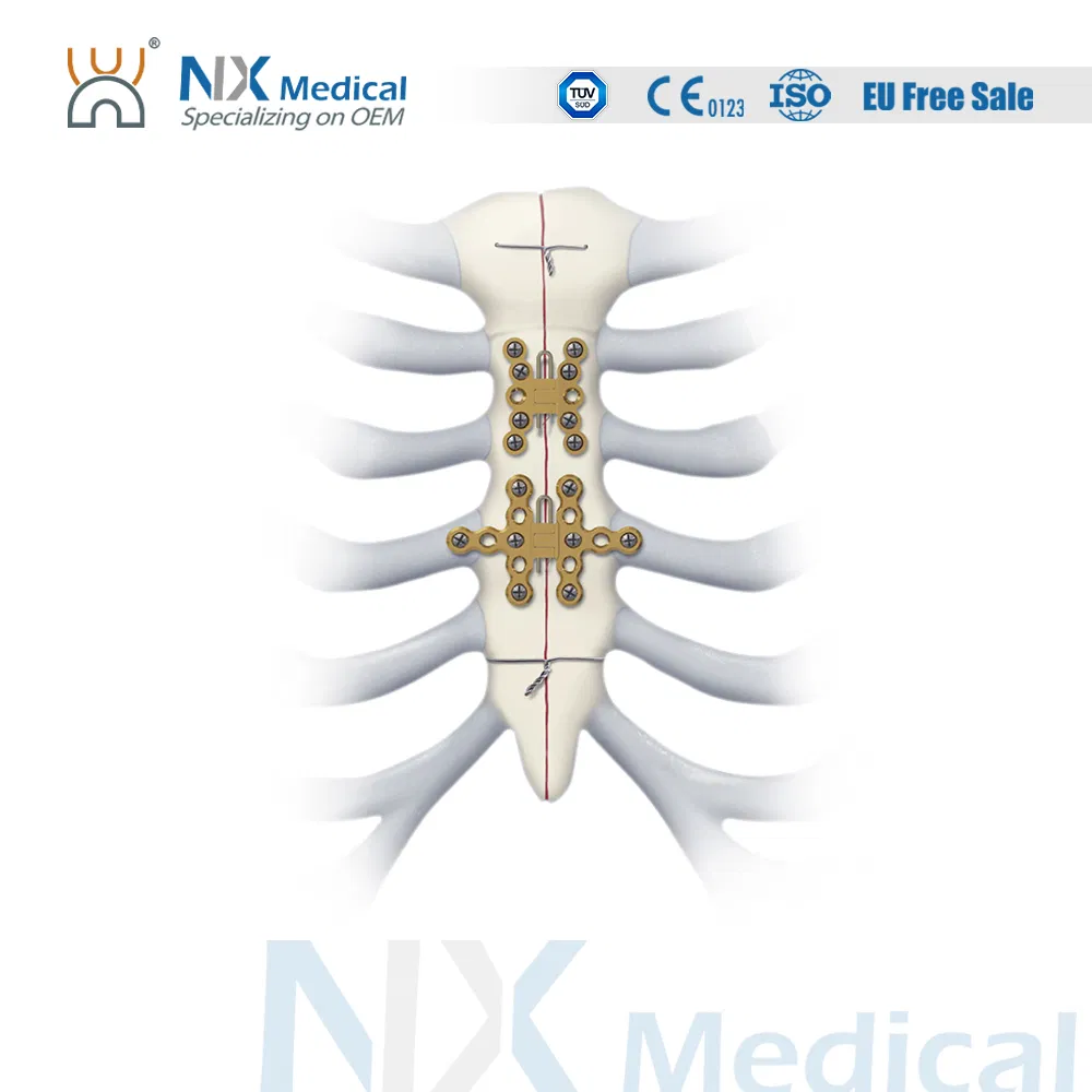 Nx Medical Locking Plates LCP Sternum 2.9mm System Implants for Orthopedic Fixation