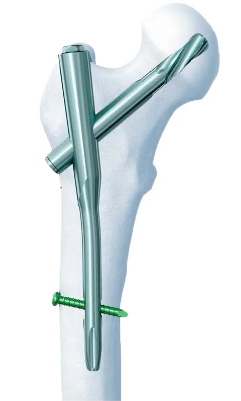 Proximal Femoral Nail System