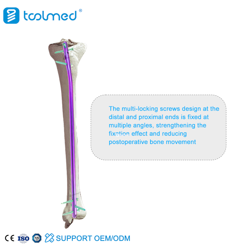 Intramedullary Nailing of Tibia Assured Quality Expert Tibia Intramedullary Nail Instrument Set