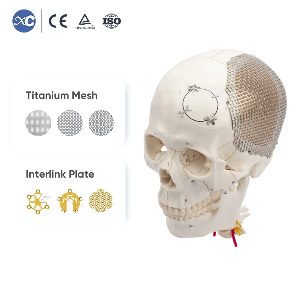 Orthopedic Maxillofacial Neurosurgery Surgical Titanium Cranial Mesh Implant