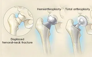 Hip Joint System Part 1