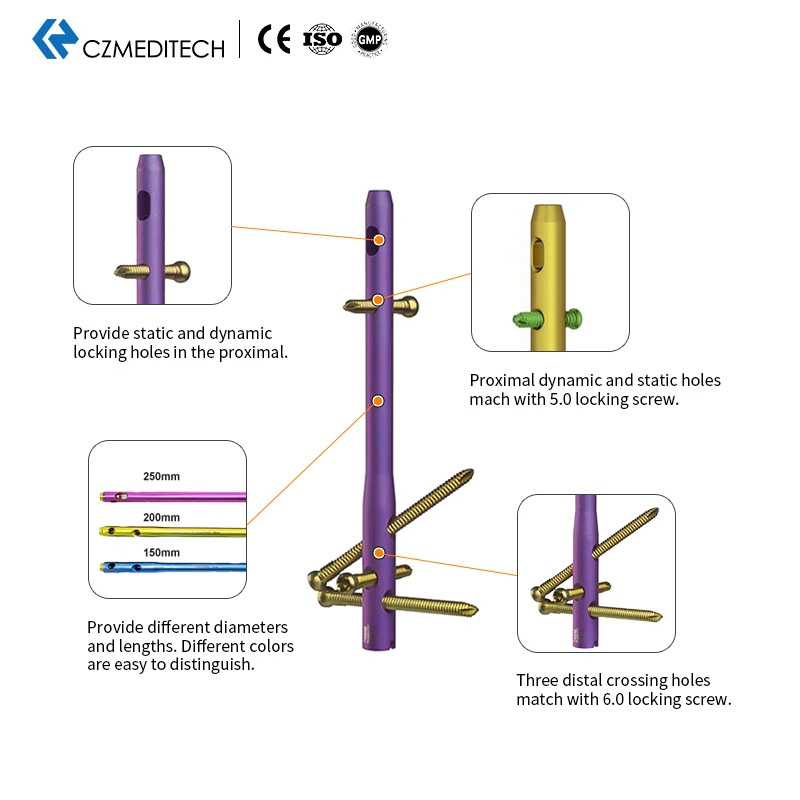 Hindfoot Fusion Ankle Intramedullary Nail Titanium Interlocking Nail Exporters Hospital Surgical Equipment