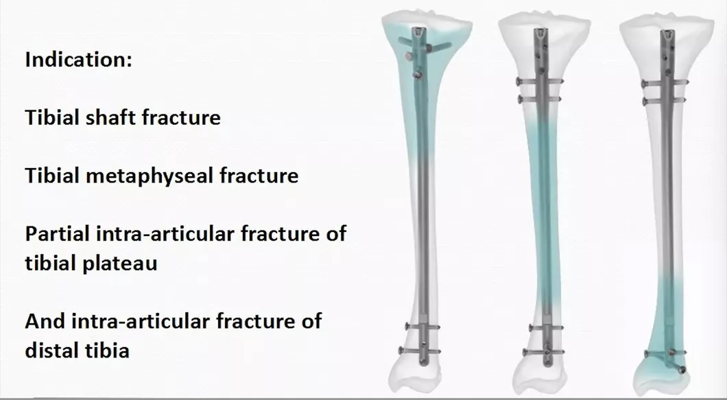 Surgical Bone Product