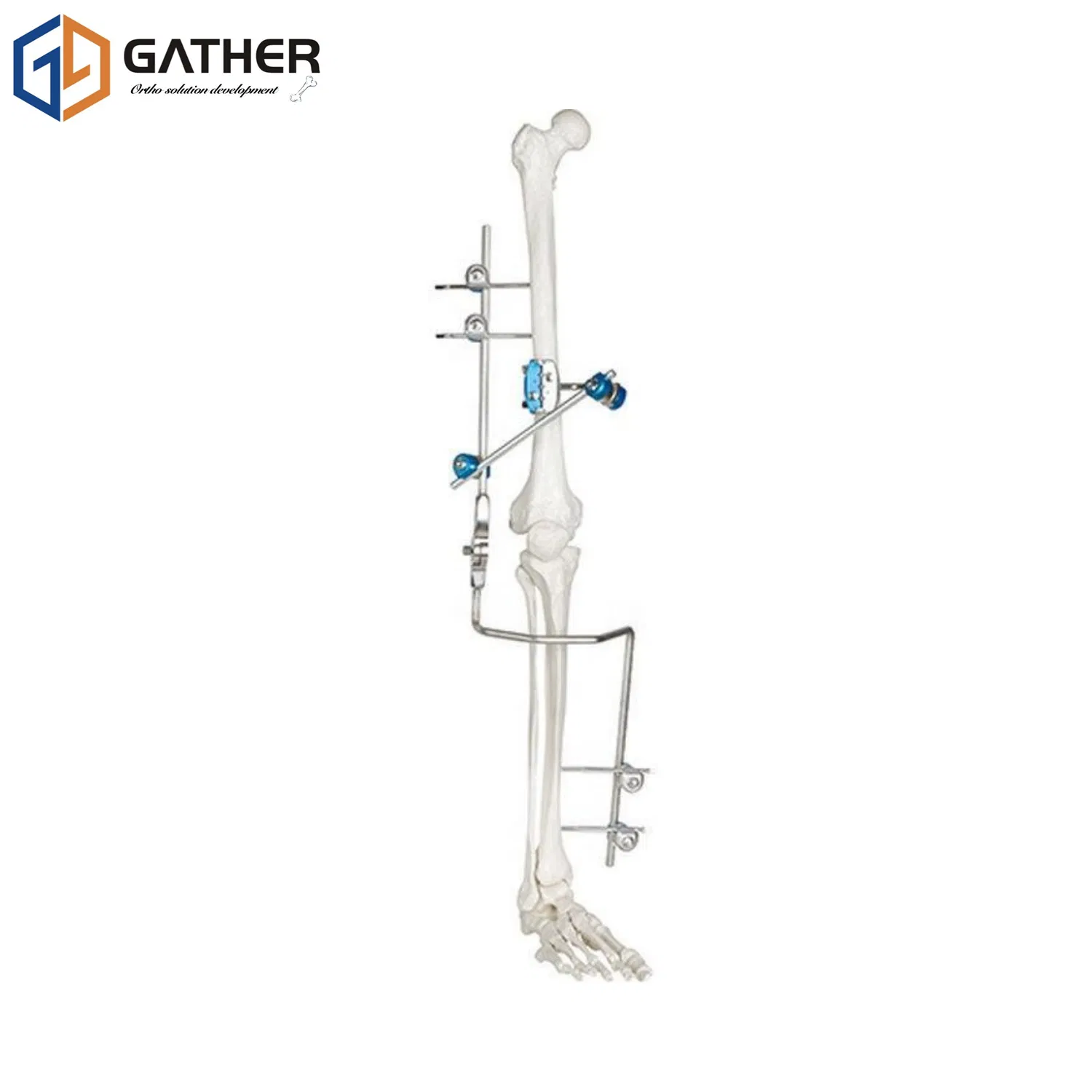 Fracture Fixation Stainless Surgical Instrument Carbon Fiber External Fixator