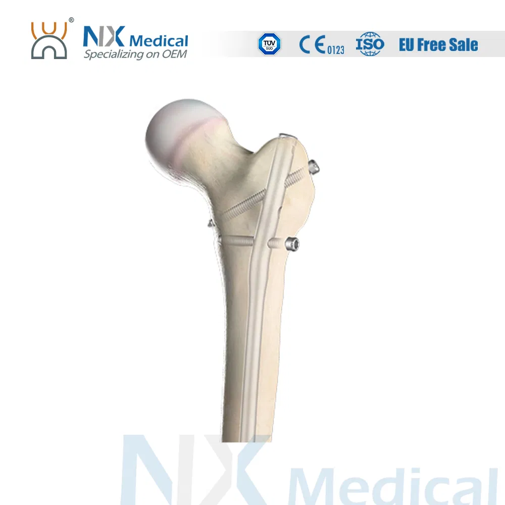 Nx Medical Interlocking Intramedullary Femoral Nail Titanium Orthopedic Implants