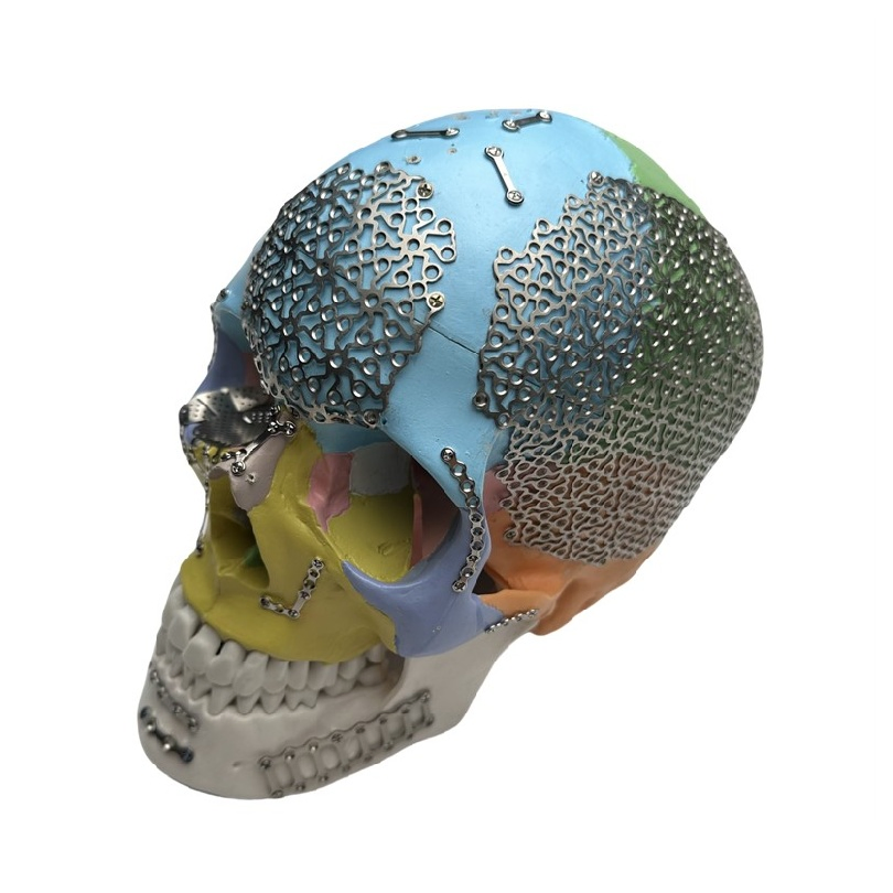Trauma Fixation Implants Skull Fracture Surgery Titanium Surgical Bone Locking Screw Orthopedic Straight Reconstruction Mini Cranial Maxillofacial Plate
