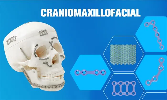 Maxillofacial Titanium Implant Plate