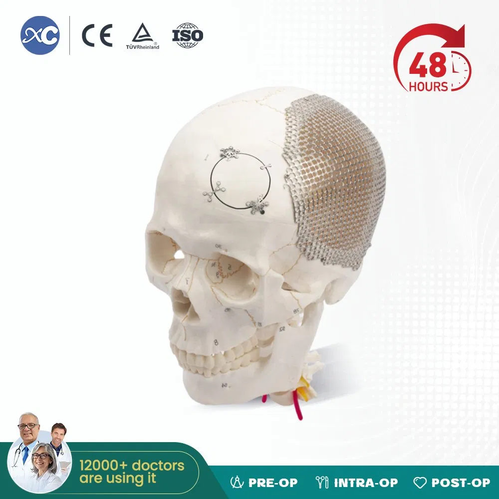 Orthopedic Maxillofacial Neurosurgery Surgical Titanium Cranial Mesh Implant